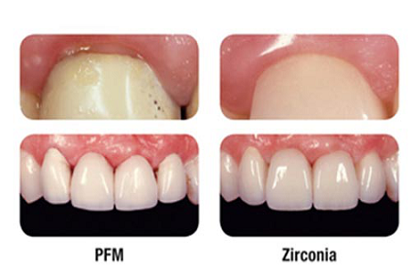 Crown And Bridges(All Type Pfm And Zirconia)
